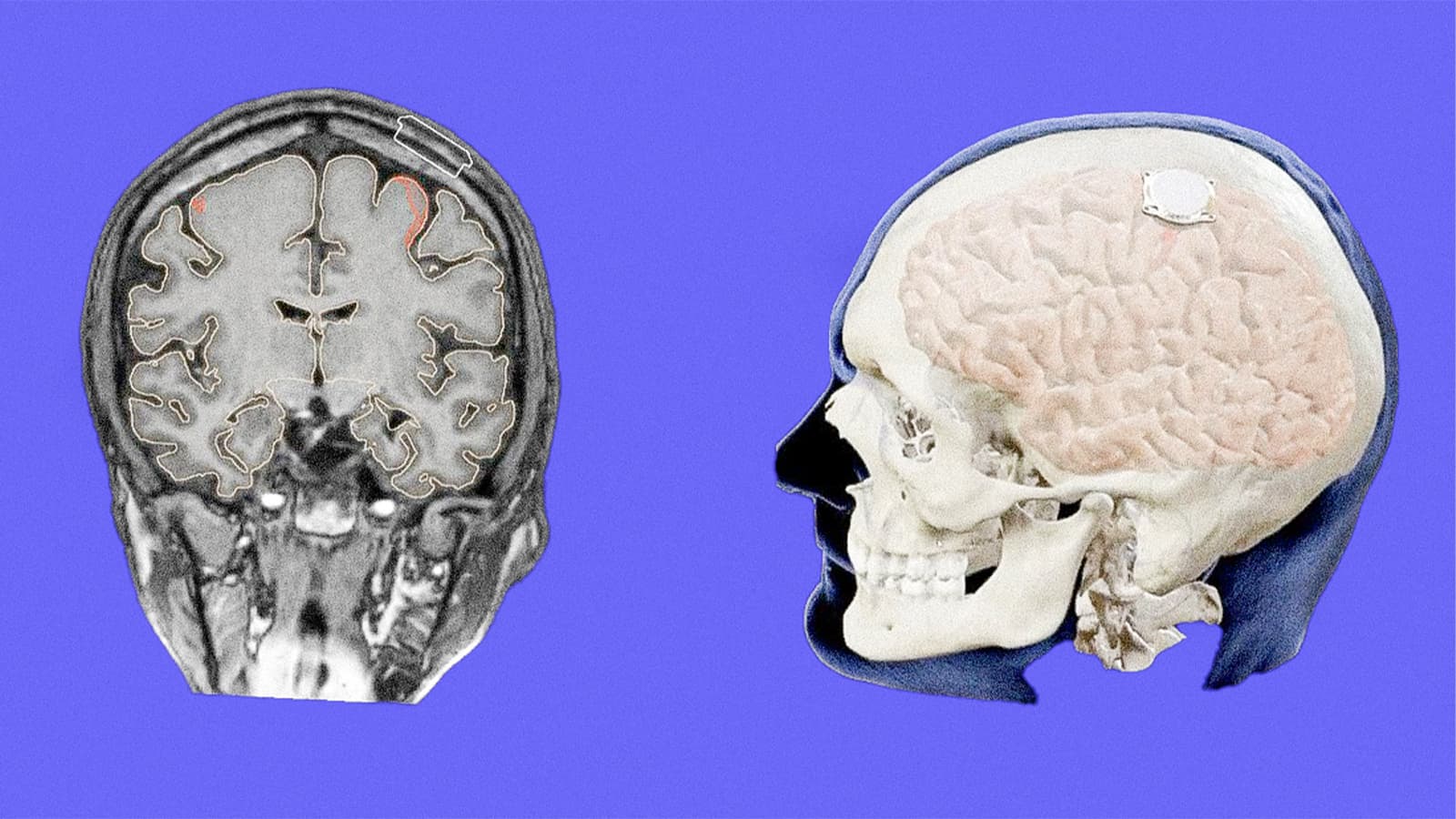Илон Масктың Neuralink-і үшінші адамның миына чип орнатты